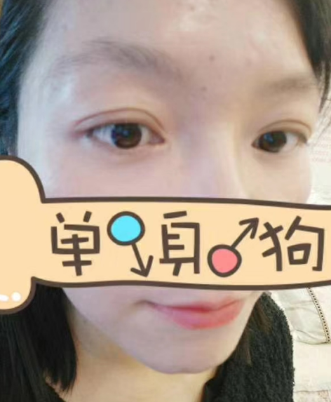 去眼袋手术