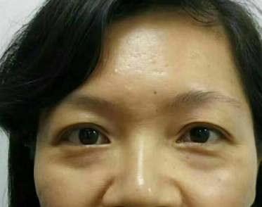 去眼袋手术