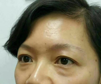 去眼袋手术