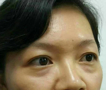 去眼袋手术