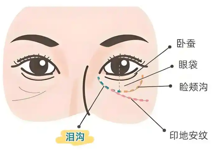 去眼袋手术