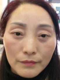 去眼袋手术