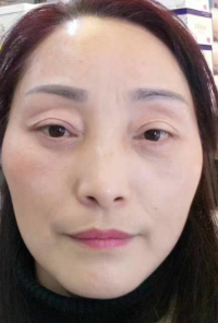 去眼袋手术