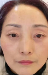去眼袋手术