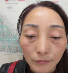 去眼袋手术