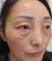 去眼袋手术