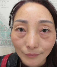 去眼袋手术