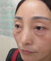 去眼袋手术