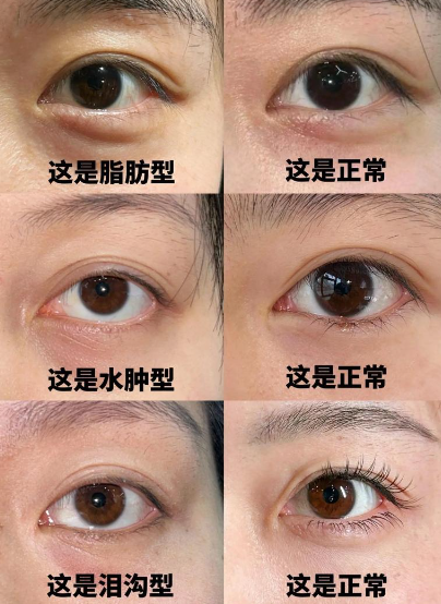 去眼袋手术