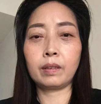 去眼袋手术