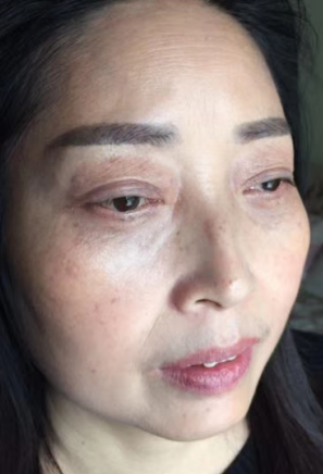 去眼袋手术