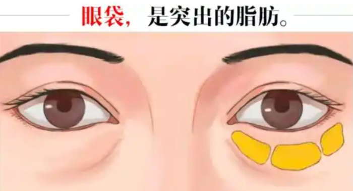 去眼袋手术