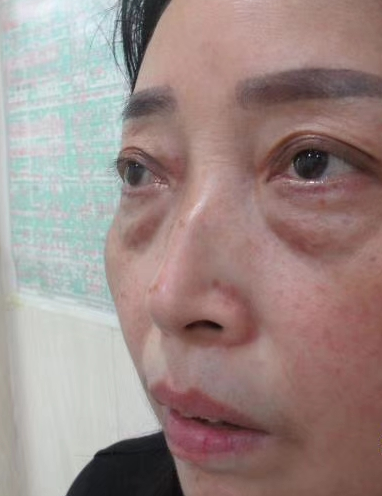 去眼袋手术