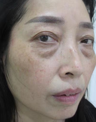 去眼袋手术