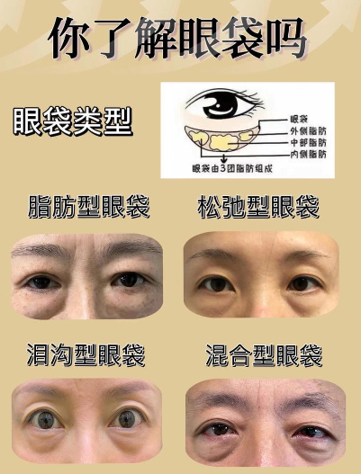 去眼袋手术