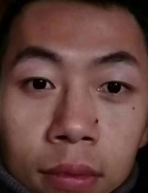 去眼袋手术