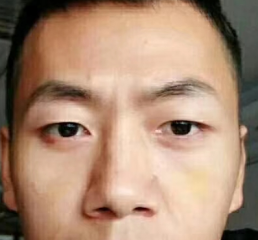 去眼袋手术