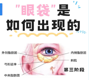 去眼袋手术