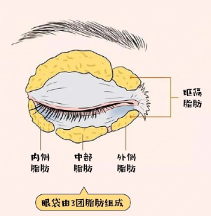 去眼袋手术