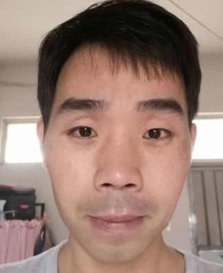 去眼袋手术