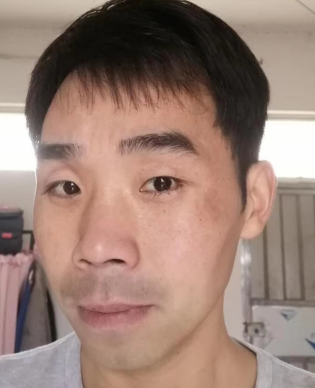 去眼袋手术