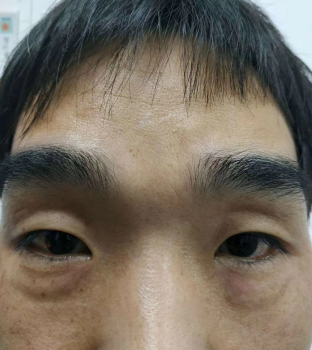 去眼袋手术