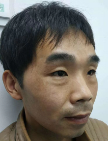 去眼袋手术