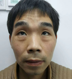 去眼袋手术