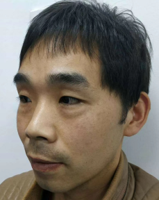 去眼袋手术
