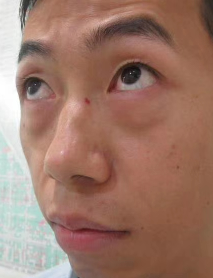 去眼袋手术
