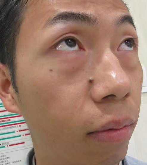 去眼袋手术