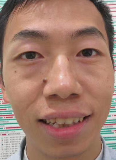 去眼袋手术