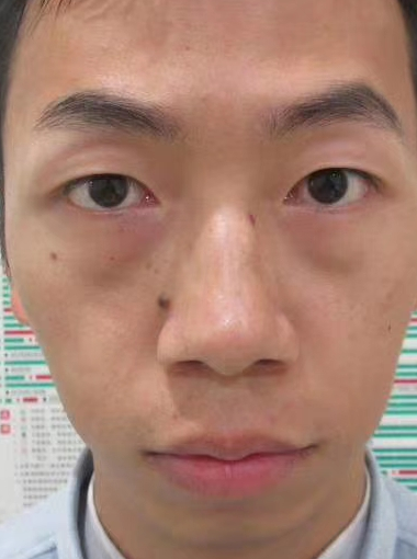 去眼袋手术