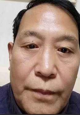 去眼袋手术