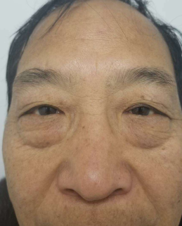 去眼袋手术