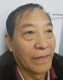 去眼袋手术