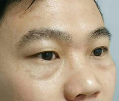 去眼袋手术