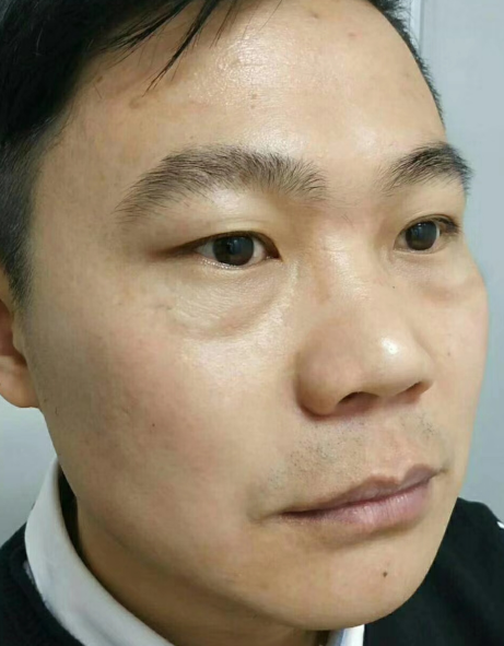 去眼袋手术