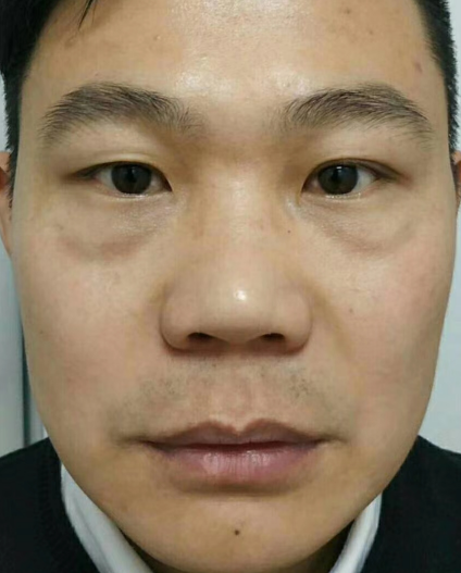 去眼袋手术