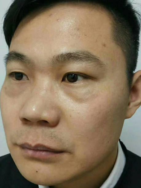 去眼袋手术