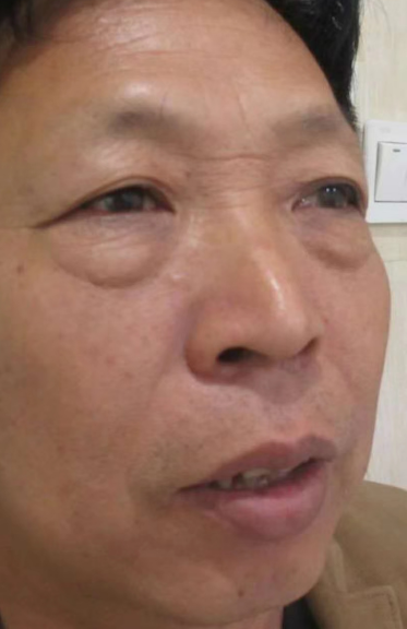 去眼袋手术