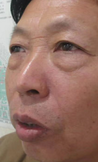 去眼袋手术