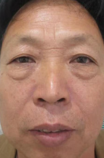 去眼袋手术