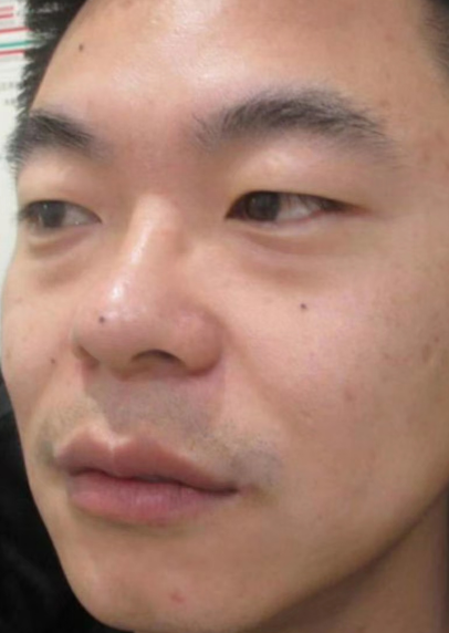 去眼袋手术