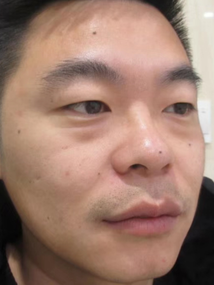 去眼袋手术