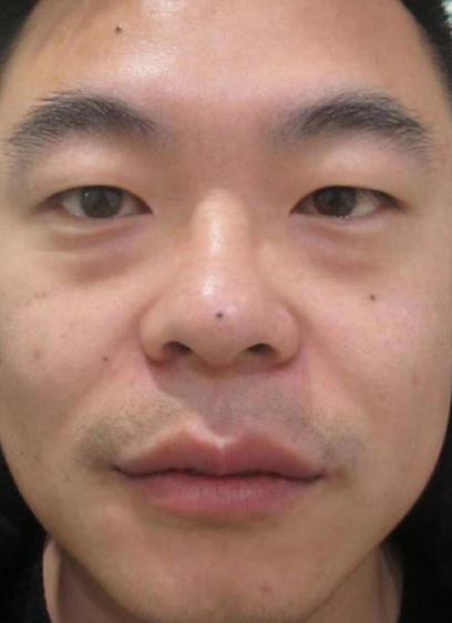 去眼袋手术