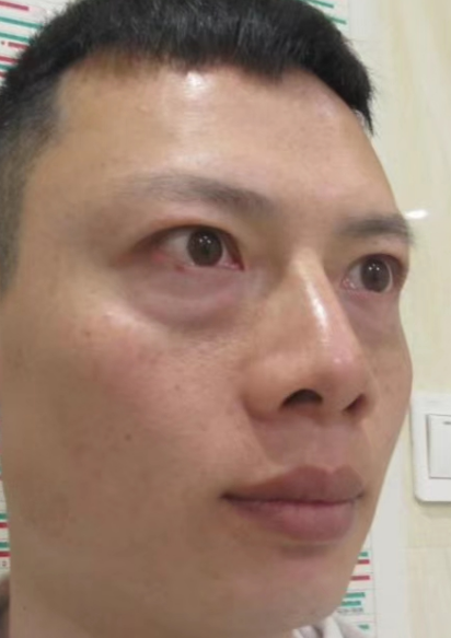 去眼袋手术