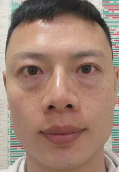 去眼袋手术