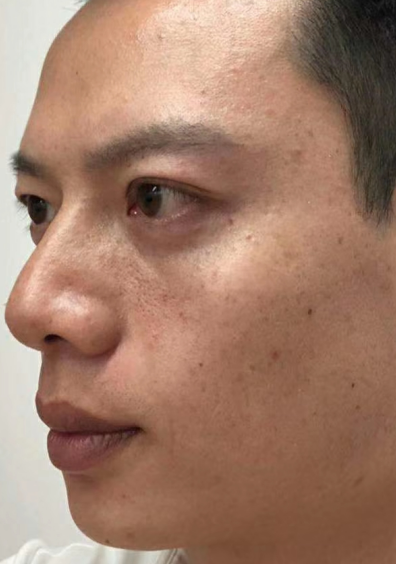 去眼袋手术
