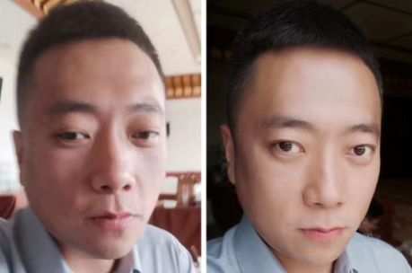 去眼袋手术